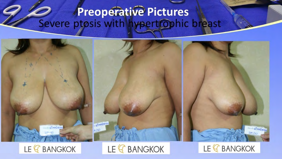 Figure 5: Patient with severe ptosis, and hypertrophic breast is managed by reduction mammaplasty with vertical scar only. This case was removed the 200 and 250gm of excess breast tissue from right and left breast respectively. Pictures show preoperatively, seventeenth day postoperatively.