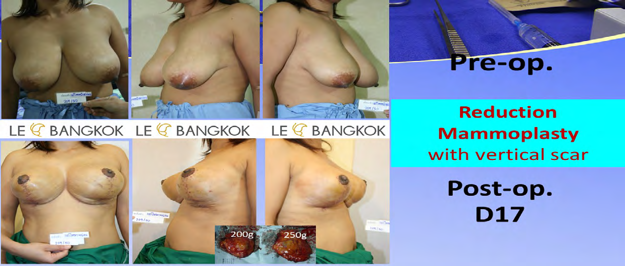 Figure 6: Case I: Patient with severe ptosis , and normal breast volume is operated previously from others by breast augmentation. This case manage by mastopexy and secondary breast augmentation with small implant. Pictures show preoperatively, five weeks postoperatively.