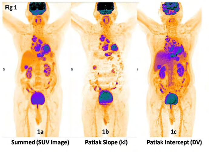 Figure 1: The quantitative parametric data obtained on Siemens Biograph Vision digital PET CT using flowmotion multiparametric PET generates three distinct images: a) Parametric images of “conventional SUV” generated by summation of the dynamic images from whole-body passes 14- 19 corresponding to 60-90 minutes post-injection. The SUV image represents the conventional 60 minutes whole body image by summation of the last few dynamic frames representing the amount of metabolized and unmetabolized tracer in the tissue at a certain point of time. This image is used for the routine clinical interpretation of findings. b) Patlak slope (ki) image: Patlak plot uses linear regression analysis to generate “slope” image representing ki or influx metabolic glucose rate which is calculated as per the equation ki= K1xk3/(k2+k3). Patlak image reconstructions are done from the second acquisition phase of whole body passes after an initial lag of 10 minutes for a total of 60 minutes duration. The ki image shows reduced normal organ uptake, particularly in the liver and represents the metabolized tracer distribution wherein each voxel represents the rate of metabolized FDG in a volume of tissue in mg/min/100 ml. The different kinetics between normal liver tissue and malignant lesions results in an increased contrast in the ki images as compared to the SUV images. In this diagnosed case of left lung carcinoma with mediastinal nodal metastasis and liver metastasis, the ki image clearly delineates all the malignant lesions due to low background activity and low noise levels. c) Patlak “Intercept” image: represents Distribution Volume (DV) of the radiotracer 18F-FDG. DV is the total blood plasma distribution volume, i.e. the sum of the distribution volume of the reversible compartment and the fractional blood plasma volume present in the tissue. In other words it represents the unmetabolized tracer in tissue that is expressed as percentage. DV is an estimate for the vascularity and interstitial fluid components of the tissue. The images are suggestive of increased vascularity in the primary left lung lesion as well as in the metastatic mediastinal nodal and liver lesions. _(Image Courtsey: Department of Nuclear Medicine, Apollo Proton Cancer Centre, Chennai, India)_.