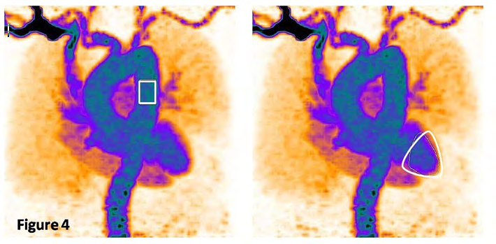 Figure 4: “Arterial input function” derived from the initial single-bed list-mode acquisition over the heart by measuring the uptake in the region of interest located in the left ventricle. The input function is measured by applying linear interpolation on the initial extracted LV ROI mean values to generate time activity curves. _(Image Courtesy: Department of Nuclear Medicine, Apollo Proton Cancer Centre, Chennai, India_. _Images obtained on Siemens_ _Biograph Vision digital PET CT using flowmotion multiparametric suite)._
