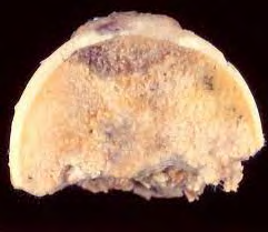 Figure 1: Aseptic necrosis of bone depicting a yellow, opaque perimeter with cracking, folding and an irregular contour [11].