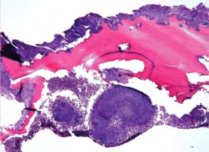 Figure 3: Aseptic necrosis of jaw bone displaying necrotic, intensely stained bone trabeculae with focal calcification, vacant lacunae and a perimeter of fibrous tissue [13].