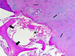 Figure 8: Aseptic necrosis of bone enunciating darkly stained trabeculae of dead bone, necrotic bone marrow elements and a perimeter of fibrous tissue [18].