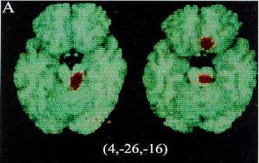 Figure 2: Posterior fossa lesions. Migraine in Children