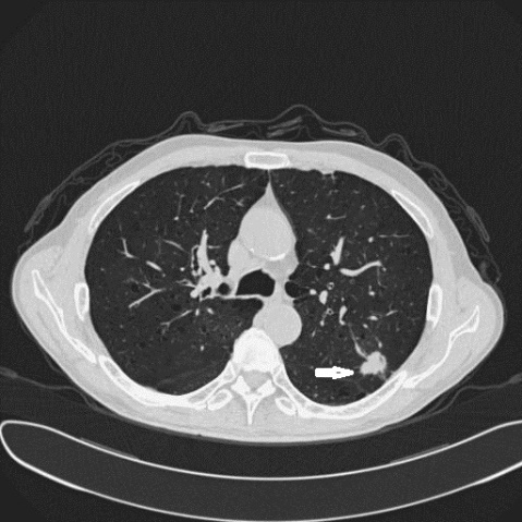 Figure 2: Male, 73 years old. The lesion was found in health examination. CT showed mass in upper lobe of the left lung. The mass had signs of vessel convergence, lobulations and speculations.