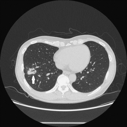 Figure 3: Male, 50 years old. He had cough for 6 weeks. CT showed mass with signs of vessel convergence as well as lobulations and speculations in low lobe of right lung, air-like shadow showing in the mass.