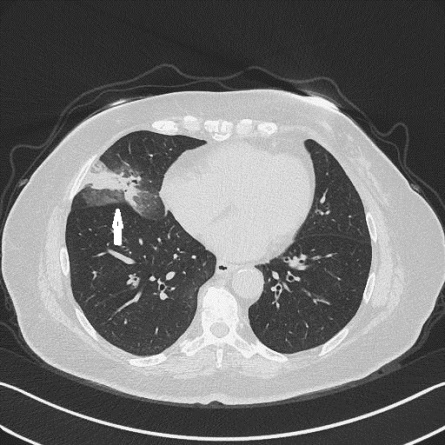 Figure 4: Female, 66 years old. Cough and fever for 1 year. CT showed consolidation with ground glass shadow around in right middle lobe. She was received pulmonary lobectomy and was diagnosed pathologically as pulmonary mucinous carcinoma.