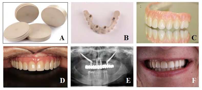 Figure 3: The results of three of 10 cases that reached 6 months of follow-up of an ongoing prospective study registered the absence of mechanical complications, adding to the 100% cumulative implant survival rate and absence of biological complications. These results, despite the short term follow- up, are positive and represent a potential broader scope of PEEK application to implant-supported fixed restorations [27].