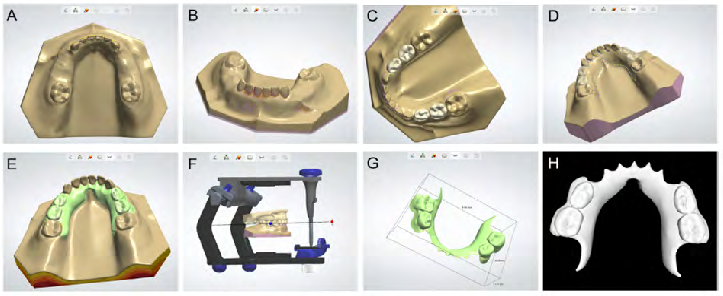 Figure 4: Digital design process for removable space maintainers; a) importing the model data; b) observing the model and filling in the voids; c) importing the artificial teeth model from the DIY deciduous teeth database into the software; d) constructing the profile of the major connector; e) composing the integrated removable space maintainer; f) using the fictitious articulator to perform occlusal adjustment; g) the final removable space maintainer; and h) the final removable space maintainer data exported in STL format.