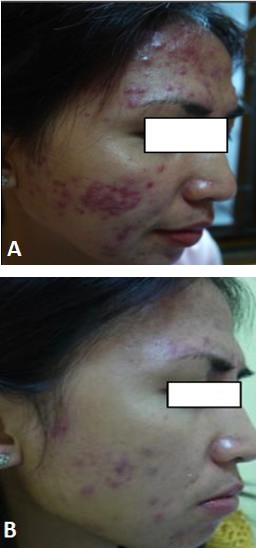 Figure 1: The degree of severity of acne vulgaris in this study after therapy there was a significant improvement in the isoflavone group. A: Before treatment(severe) B: After treatment (mild) The degree of severity of acne vulgaris in this study after therapy there was a significant improvement in the isoflavone group, while the control group did not improve (Figure 1). Acne vulgaris severity after treatment in the two groups showed a statistically significant difference (p<0.05) (Table 2).