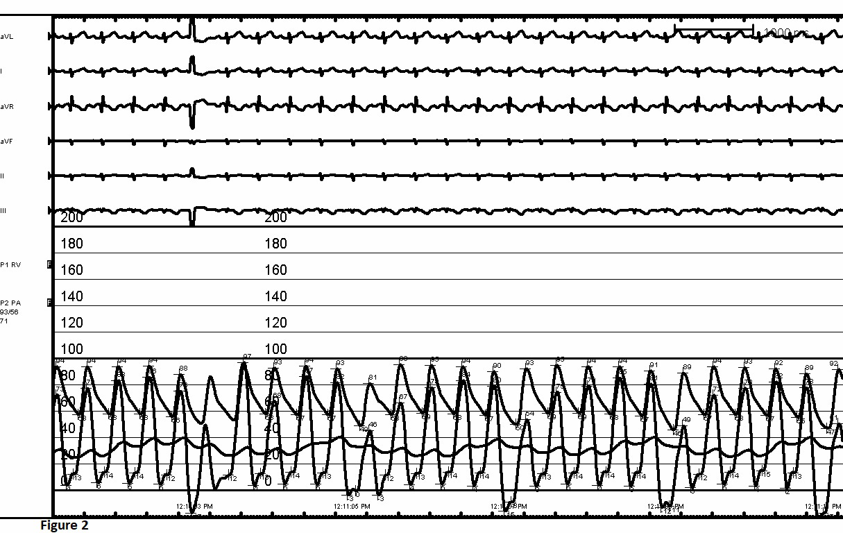 Figure 2: FA and RV Tracing Following BPV.