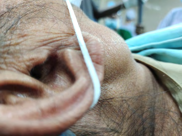 Figure 1: Pre -operative image showing swelling in the retromandibular region.