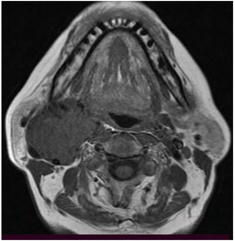 Figure 3: T2 MRI showing hyperintense lesion with multiple flow voids.