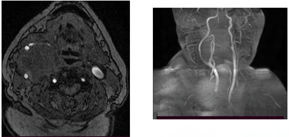 Figure 5: MRA showing splaying of carotid vessels by the tumor, there is no enhancement of mass by the contrast.