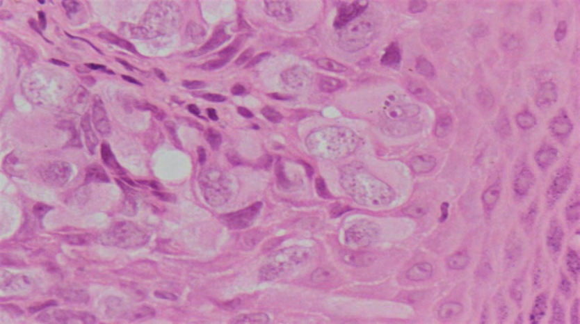 Figure 1: B/L Erdded Nipples. Figure 2: Histopath Slide.