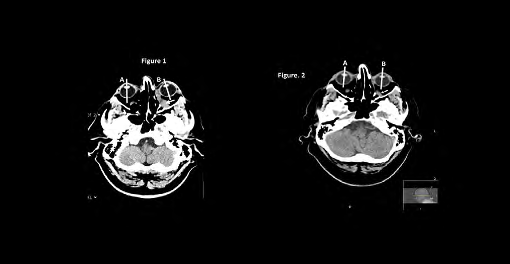 Figure 1: Computer tomography of a head shows left posterior intraorbital mass (GPA infiltrate) (white arrow), obstructing entrance of ocular nerve with internal deviation of left ocular nucleus (white A-B lines). Figure 2: Three months later after rituximab and corticosteroid therapy an angle between axial ocular lines of both eyes vanished and significant reduction of the inflammatory mass (arrow) followed.