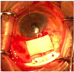 Figure 1: Per-operative picture showing tutoplast fixation.