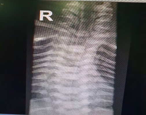 Figure 1: Chest x-ray showed vertebral abnormalities in form of multiple hemi vertebra.