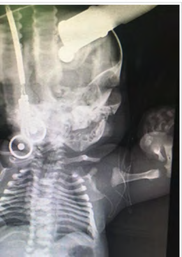 Figure 2: Chest x-ray showed ribs, under developed lung.