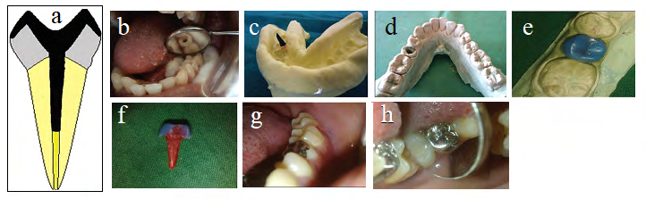 Figure 1: a) Sharonlay design, b) Prepared tooth 35 to receive Sharonlay, c) Impression, d) Master cat, e) Indirect pattern construction for Sharolay, f) Pattern of the Sharonlay restoration, g,h) Finished cemented Sharonlay restoration intra orally [12].