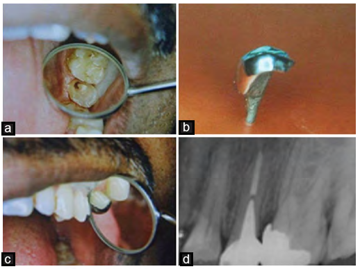 Figure 5: (a) Prepared tooth to receive SHARONLAY on left maxillary second premolar (b) Finished and contoured SHARONLAY (c) SHARONLAY after cementation on left maxillary second premolar (d) Post cementation radiograph on left maxillary second premolars [13].