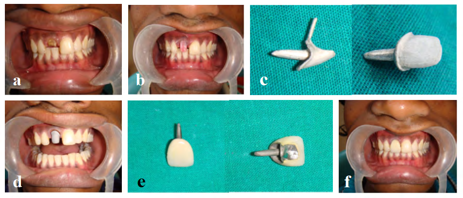 Figure 3: Richmond crown: a) pre-operative view showing dislodged fixed prosthesis on tooth 11 and clinically having very less overjet and deep bite, b) post and core + crown coping build-up in pattern resin, c) casted post and core + crown coping assembly, d) post and core + crown coping assembly checked intra-orally for fit and clearence for ceramic build-up, e) final prosthesis, and f) final prosthesis intra-orally [15].
