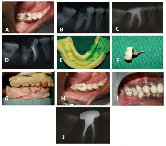 Figure 5: A) Pre-treatment photo, B) Preop-radiograph, C) X-ray after obturation, D) Post hole preparation, E) Impression for post space together with overall impression, F) Rchmond crown, G) Occlusion of Richmond crown on cast, H) Cementation of Richmond crown, I) Post treatment and Richmond crown in occlusion, and J) Post treatment x-ray of Richmond crown insitu.