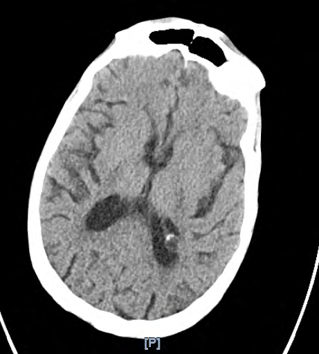 Figure 1: CT Head demonstrating central volume loss with ventricular dilatation.