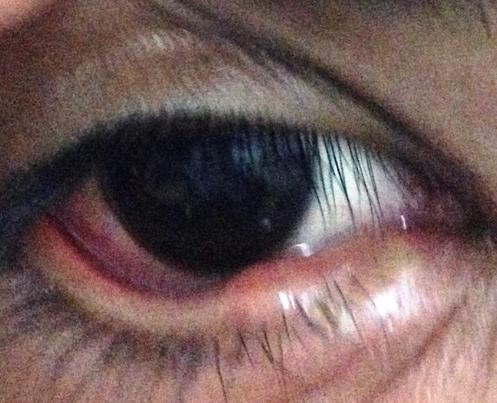 Figure 1: Image of right eye showing cut marks.