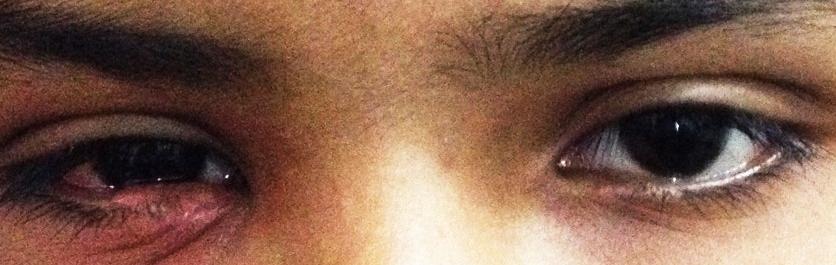 Figure 2: Image of both eyes.