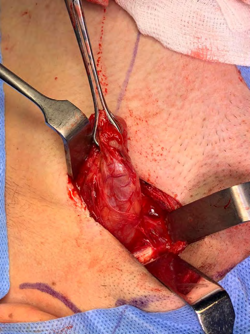 Figure 4: Intra-operative view of branchial cleft cyst; anterior and posterior inter-tendon of the digastric muscle.