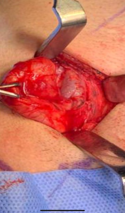 Figure 5: Intra-operative view of the internal jagular vein.