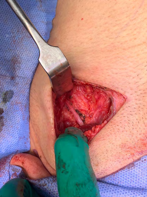 Figure 6: Intra-operative view; accessory nerve.