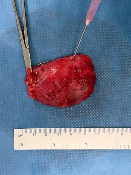 Figure 8: Excised Brancial Cleft Cyst injected with saline.