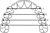 Figure 1: Measurements carried out on the dental casts. 1 Inter-canine distance, 2 Inter-first premolar distances, 3 Inter-second premolar distances, 4 Inter-molar distance.