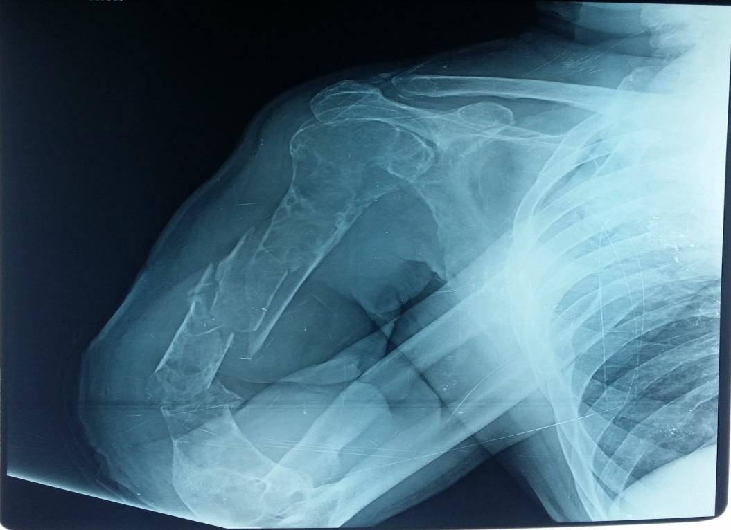 Figure 1: Neglected humeral fracture