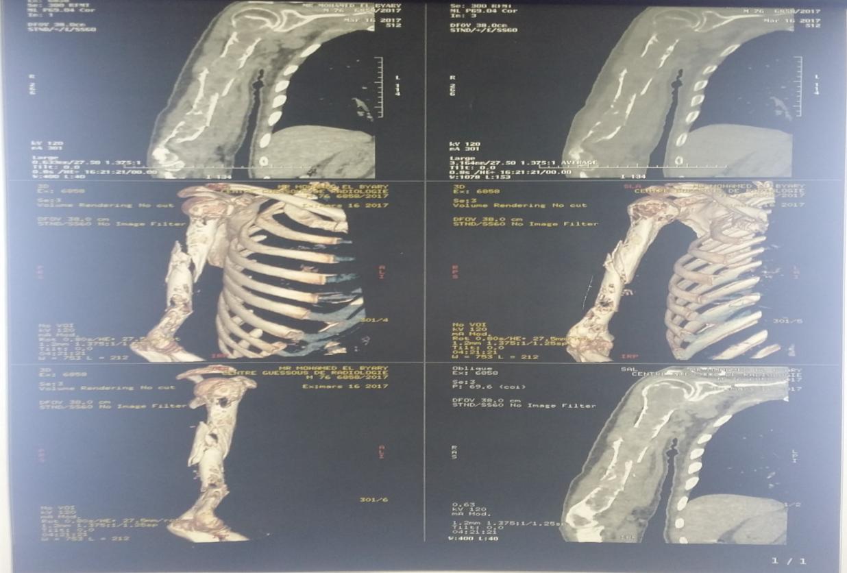 Figure 2: Arm CT scan.