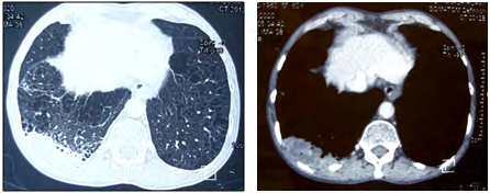 Figure 2: CT scan (Lung window and Bony window) showing right sided sub-pleural lower lobe mass prior to ATT initiation.