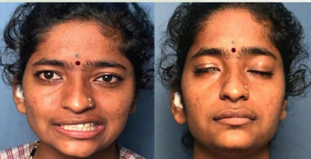 Figure 2: Harvested Temporalis fascia graft was placed over facial canal, lateral semi-circular canal and middle ear was obliterated with soft tissue and adequate meatoplasty was done. Post operatively patient was followed up every week till 4 weeks along with facial physiotherapy, facial nerve showed steady improvement with return to normal function at the end of 4th week (Figure 3).