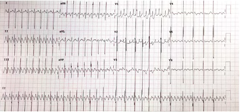 Figure 1: Electrocardiogram showing the typical “saw tooth” pattern of atrial flutter with 3:1 atrioventricular conduction in lead ll.