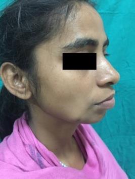 Figure 1: The swelling presented as a painless mass of size of 2 cm X 1.5 c. The skin over the anteroinferior aspect of the swelling had blind spot (punctum).