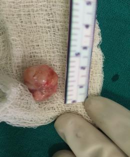 Figure 2: The mass was encapsulated with small multilobulated surface and pale yellowish appearance.