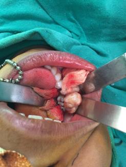 Figure 3: The mass was dissected free from overlying skin.
