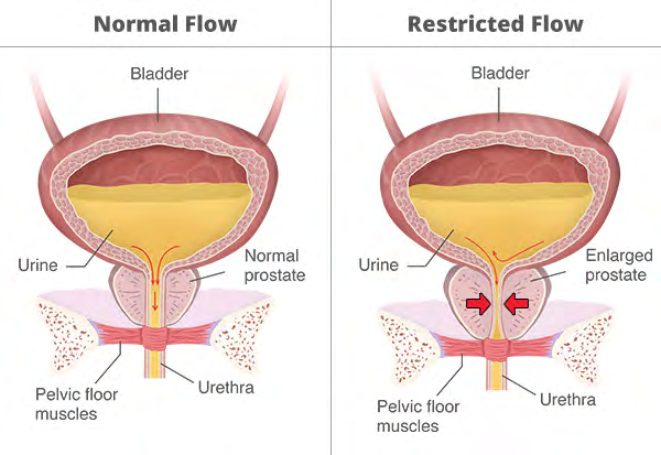 Figure 1: Urinary Retention.