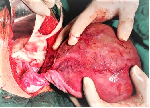 Figure 3: Right side fallopian tube and ovary, congenitally absent.
