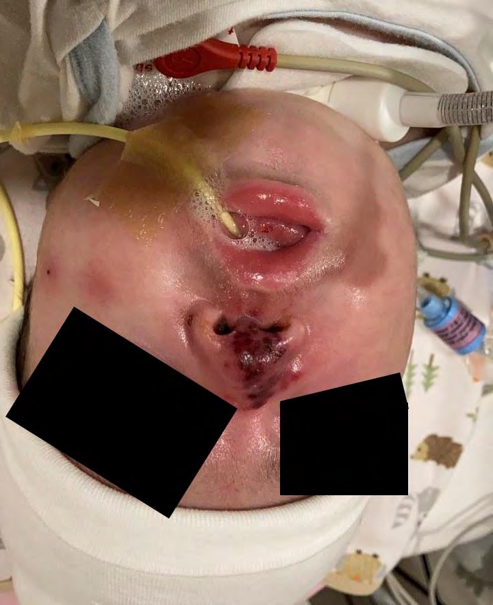 Figure 1: Multiple confluent skin lesions, non-blanchable, persistent, dark red to dark purple, hemorrhagic patches and plaques that occurred on the previously described skin pathology with characteristic branched configuration. Lesions relatively small (0.5 to 1 cm) in diameter, confluent and limited to Nose with peripheral erythema. Small solitary lesions with central necrosis and peripheral erythema noted on cheeks.
