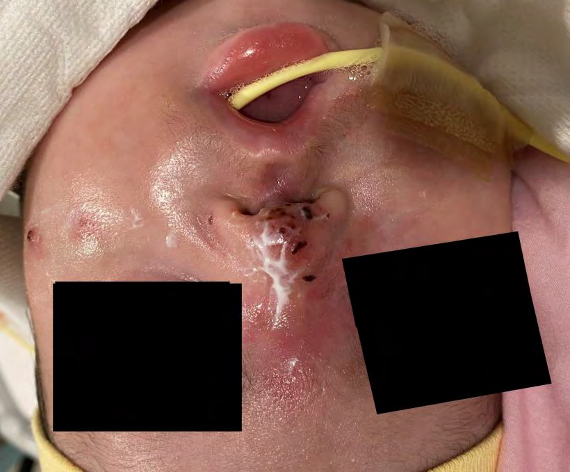 Figure 2: Gradual resolution of previously described lesions.
