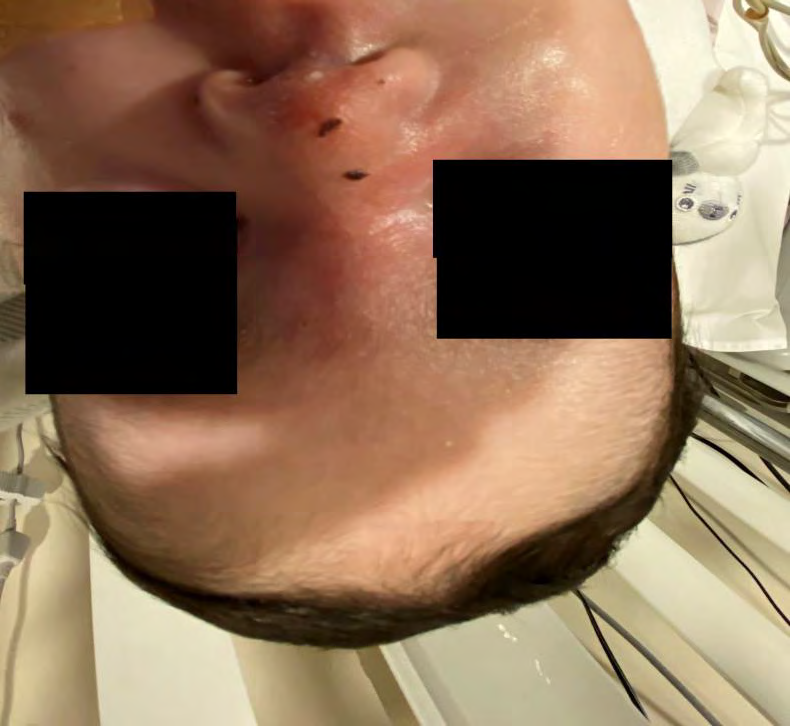 Figure 3: Further improvement of previously described lesions.