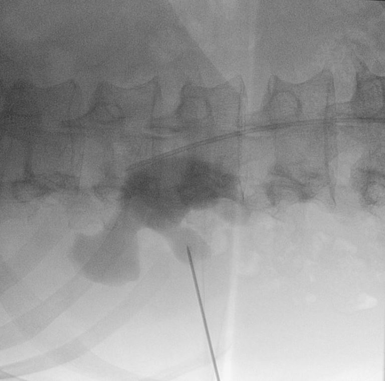 Figure 4: Monoplanar puncture through the middle calyx.