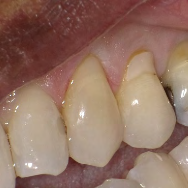 Figure 2: Baseline postoperative photograph of FS #11.